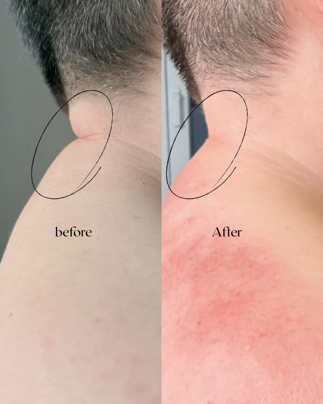 Voor en na cupping behandeling
